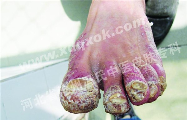 银屑病的病因都有什么 银屑病有效治疗方法|沧