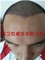 广西植发推荐机构/发之友 供应信息