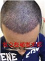 广西植发费用/发之友 供应信息